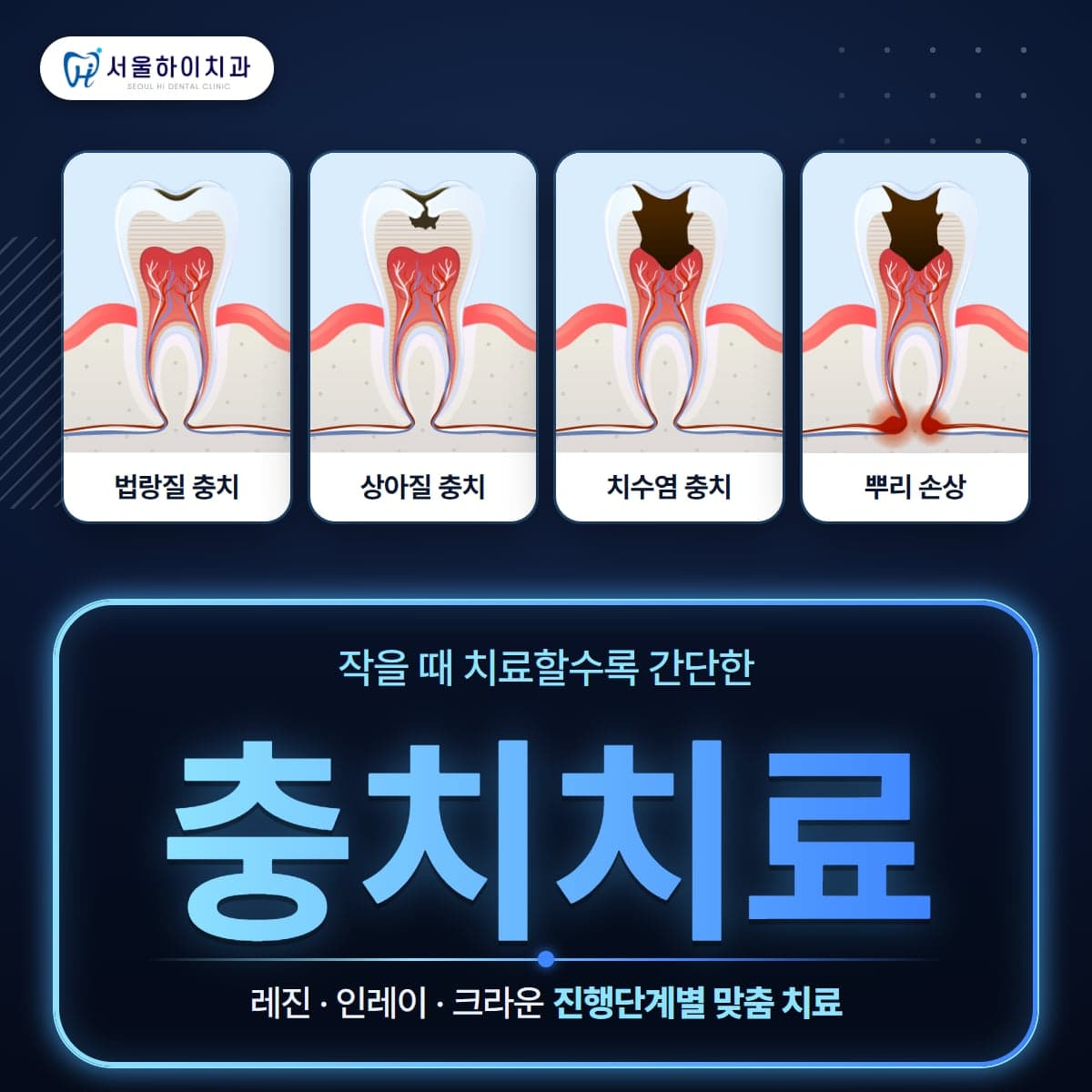 판교치과 충치치료 – 법랑질 충치부터 뿌리 손상까지 충치 진행단계 그림