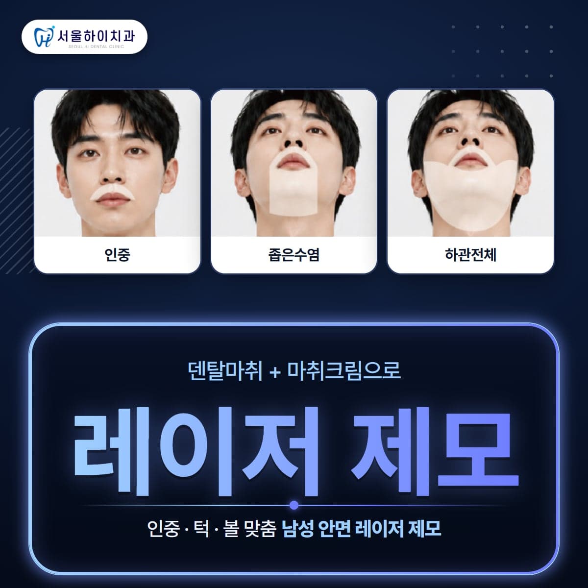 판교치과 서울하이치과 남성 안면 레이저 제모 – 인중 · 좁은수염 · 하관전체 부위