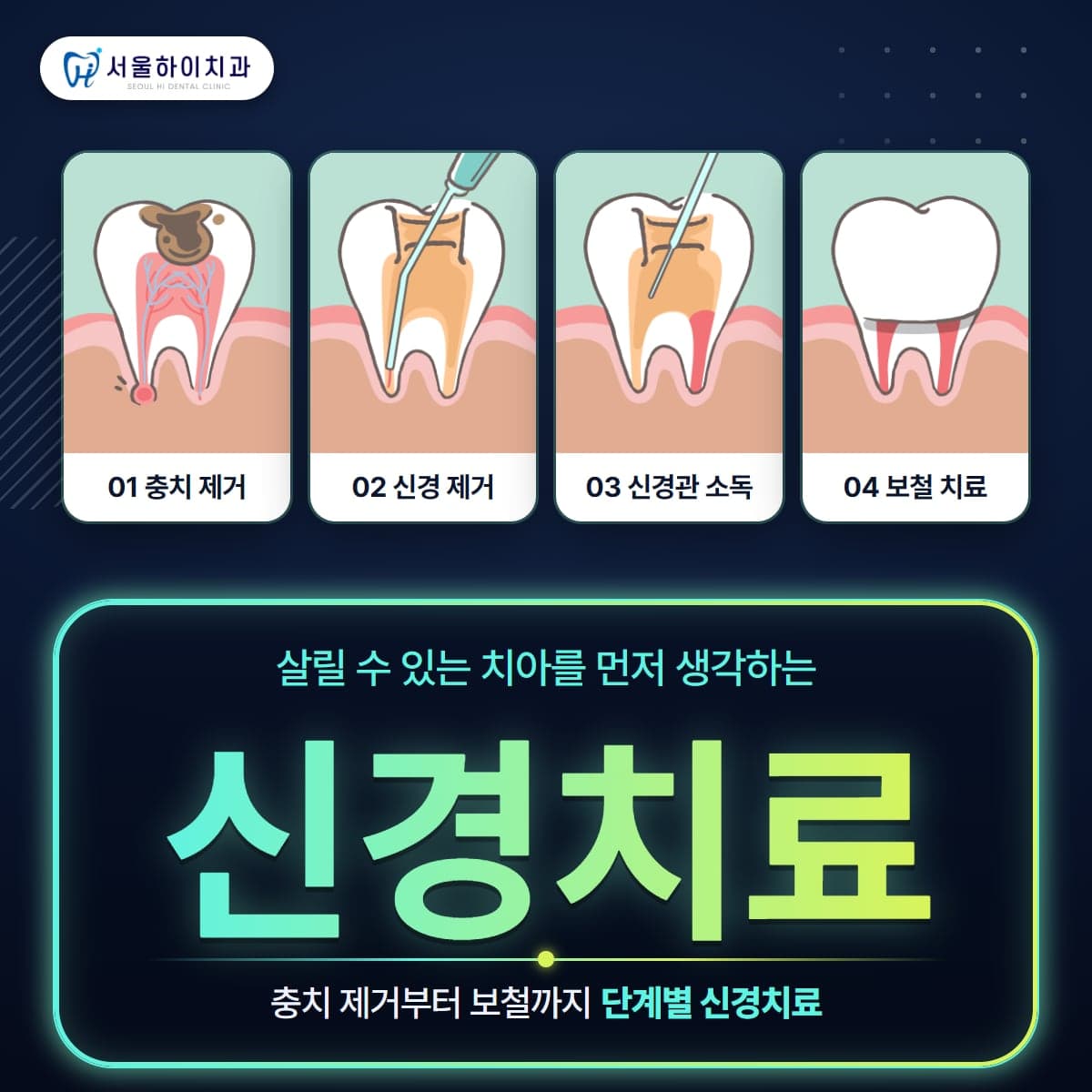판교치과 신경치료 – 충치 제거부터 보철까지 4단계 신경치료 과정 그림