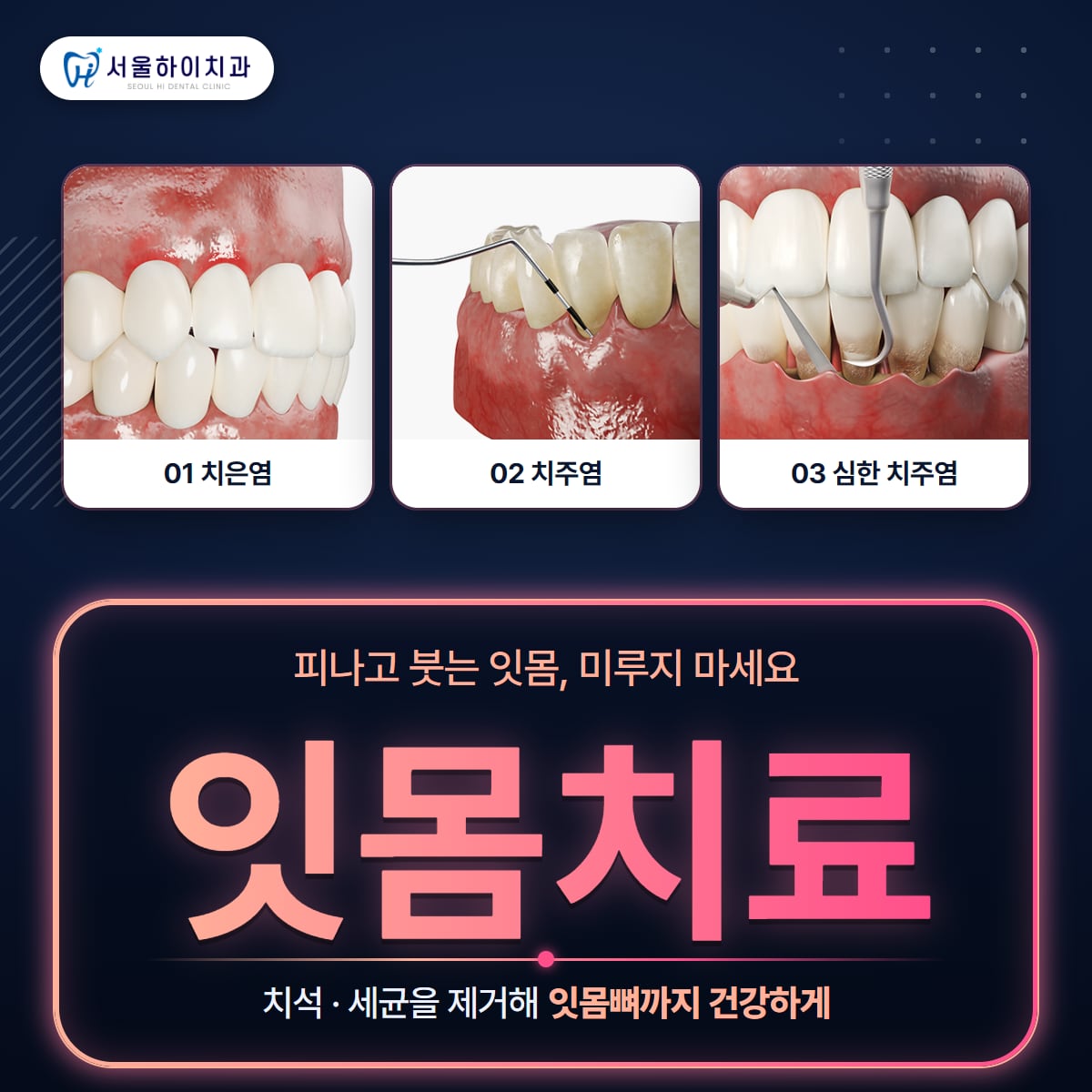 판교치과 잇몸치료 – 치은염 · 치주염 · 심한 치주염 단계 그림