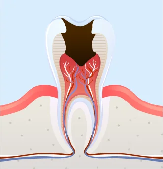 충치 3단계 치수염 충치 그림