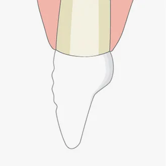 판교치과 라미네이트 1단계 – 검진할 치아 그림