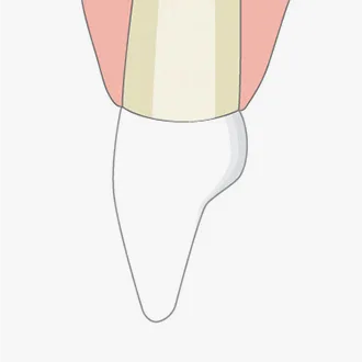 판교치과 라미네이트 4단계 – 치아에 보철을 붙인 그림