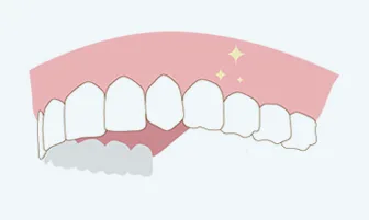 판교치과 치아미백 4단계 – 미백 광선을 비추는 그림